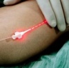 Лазерное лечение варикозных вен